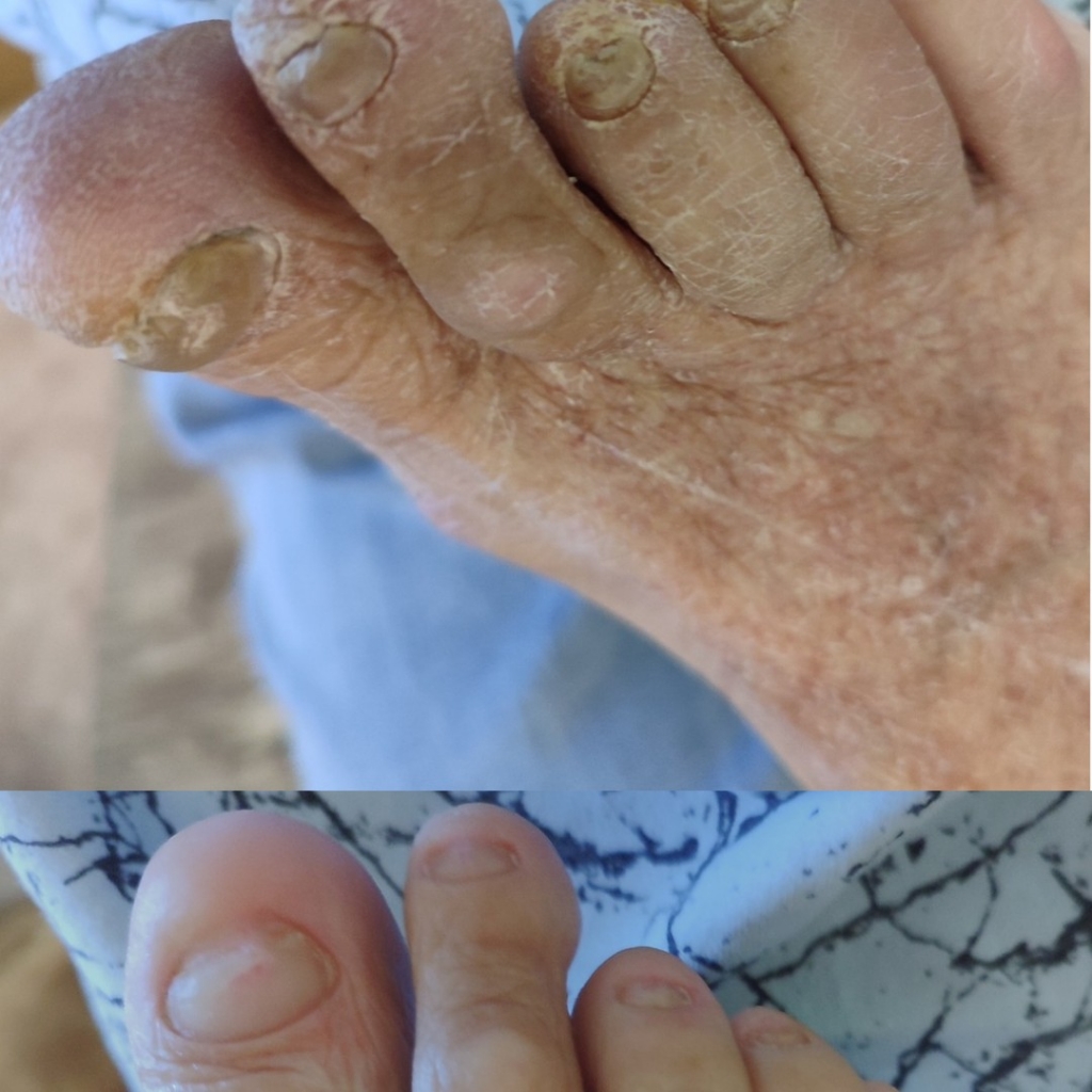 Обработка ногтей, пальцев ног пожилым и маломобильным людям