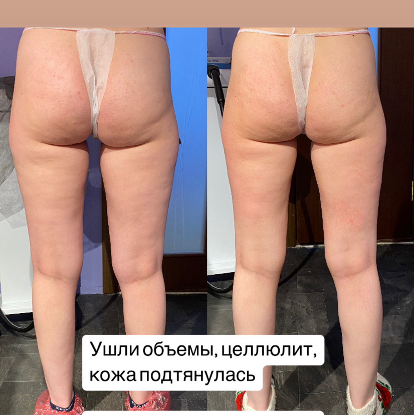 Коррекция фигуры и кожи VIP курс Зоны на выбор: ВЕРХ: живот, бока, спина/ НИЗ: ноги полностью, бедра, ягодицы/ Все тело, если объемы небольшие