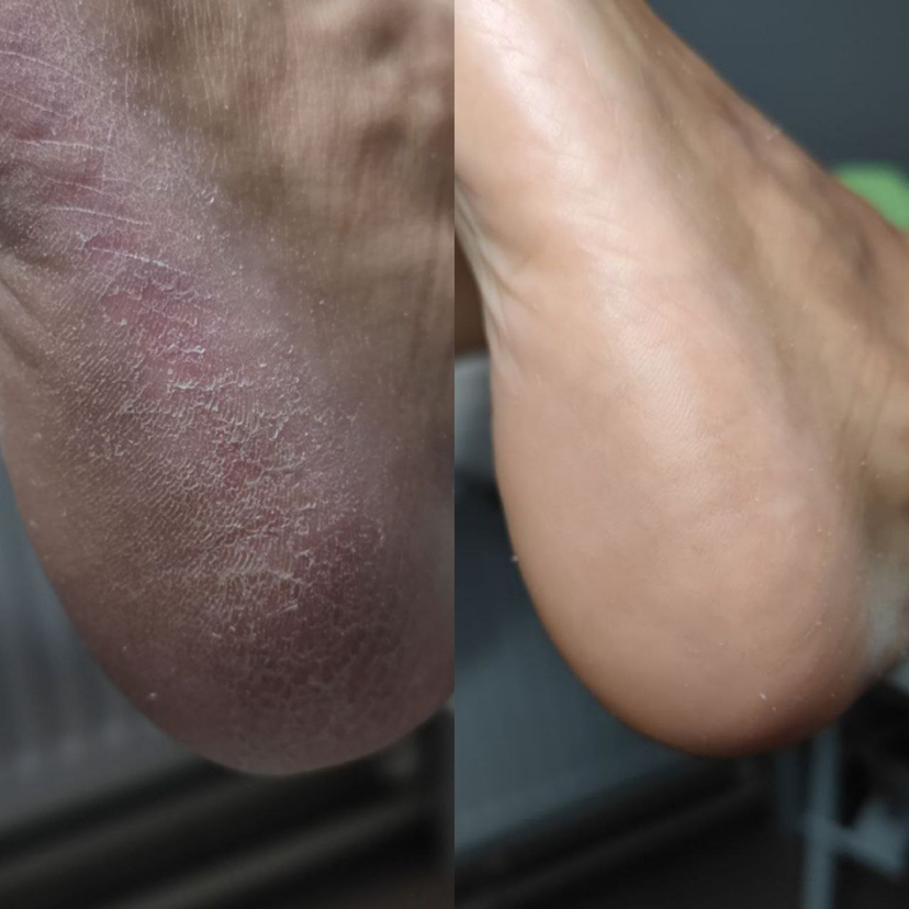 Препаратный (пилинговый) педикюр Clearance (Стопа+пальчики)