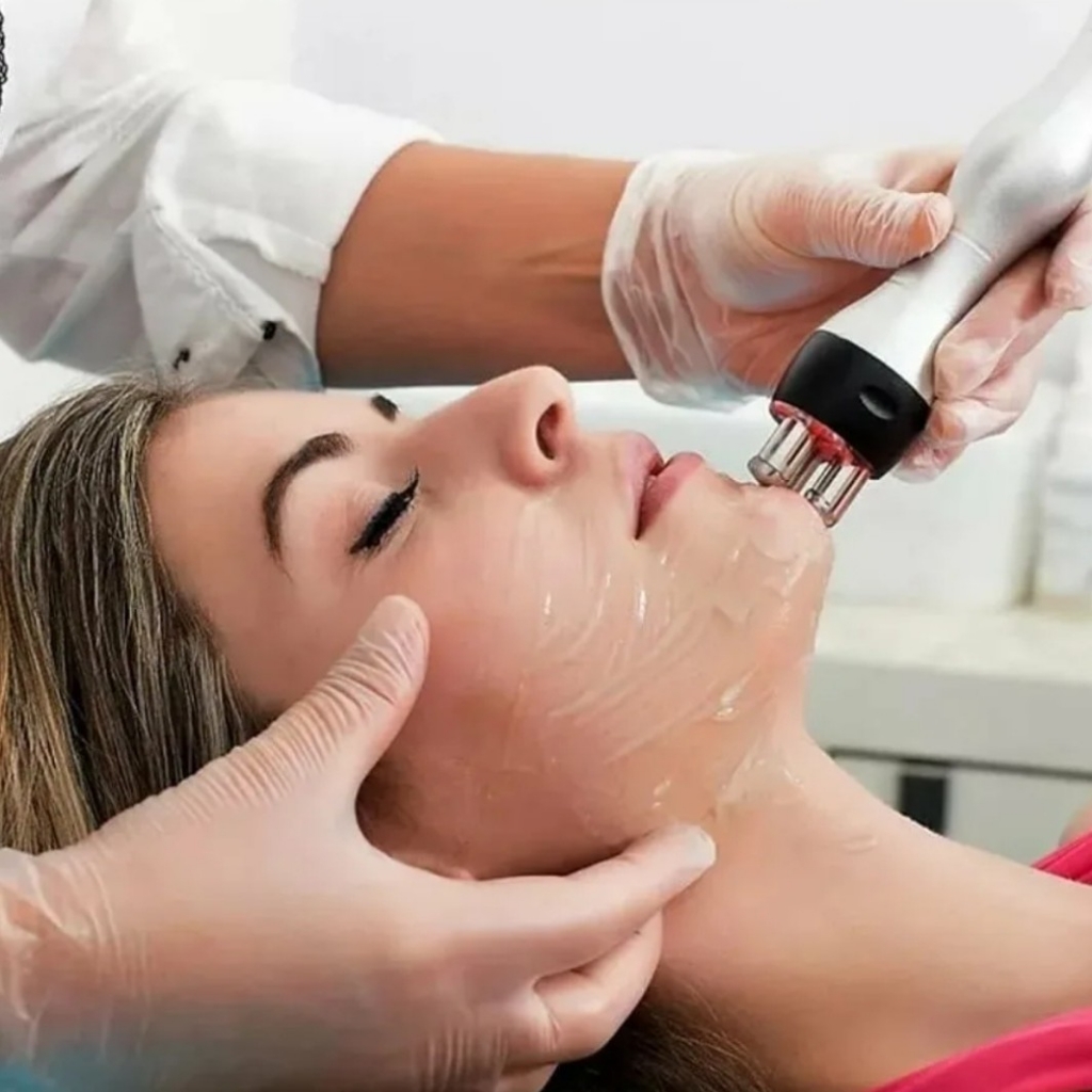 RF-Лифтинг лица