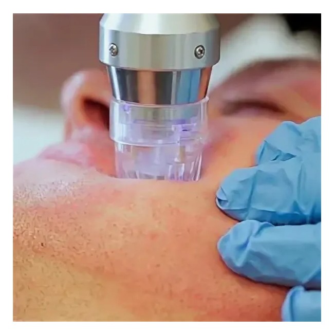 кисти рук Микроигольчатый RFЛифтинг