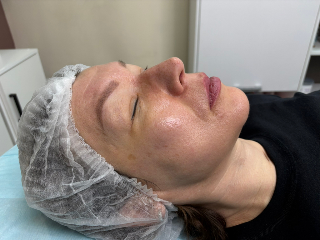 Химический пилинг-молочный