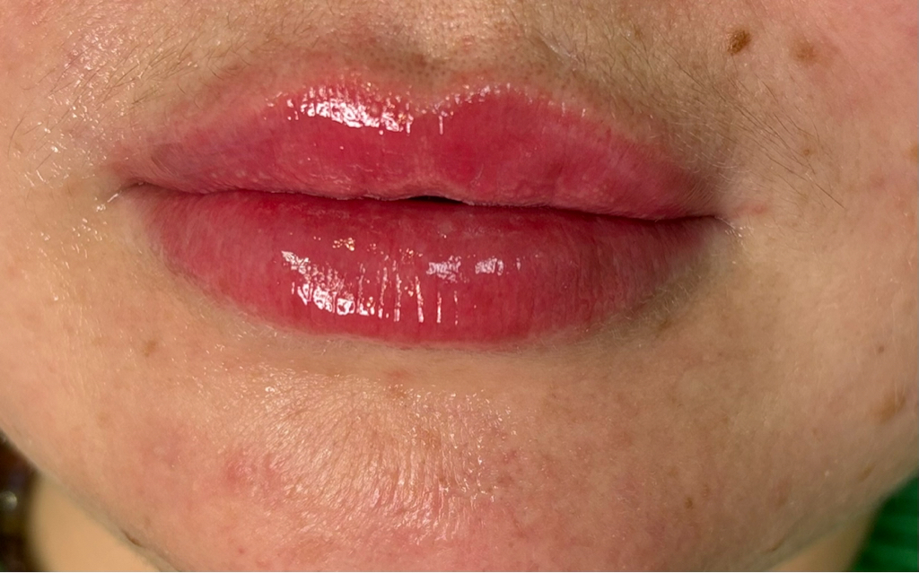 Контурная пластика  губ Беллатеро 0.6 мл