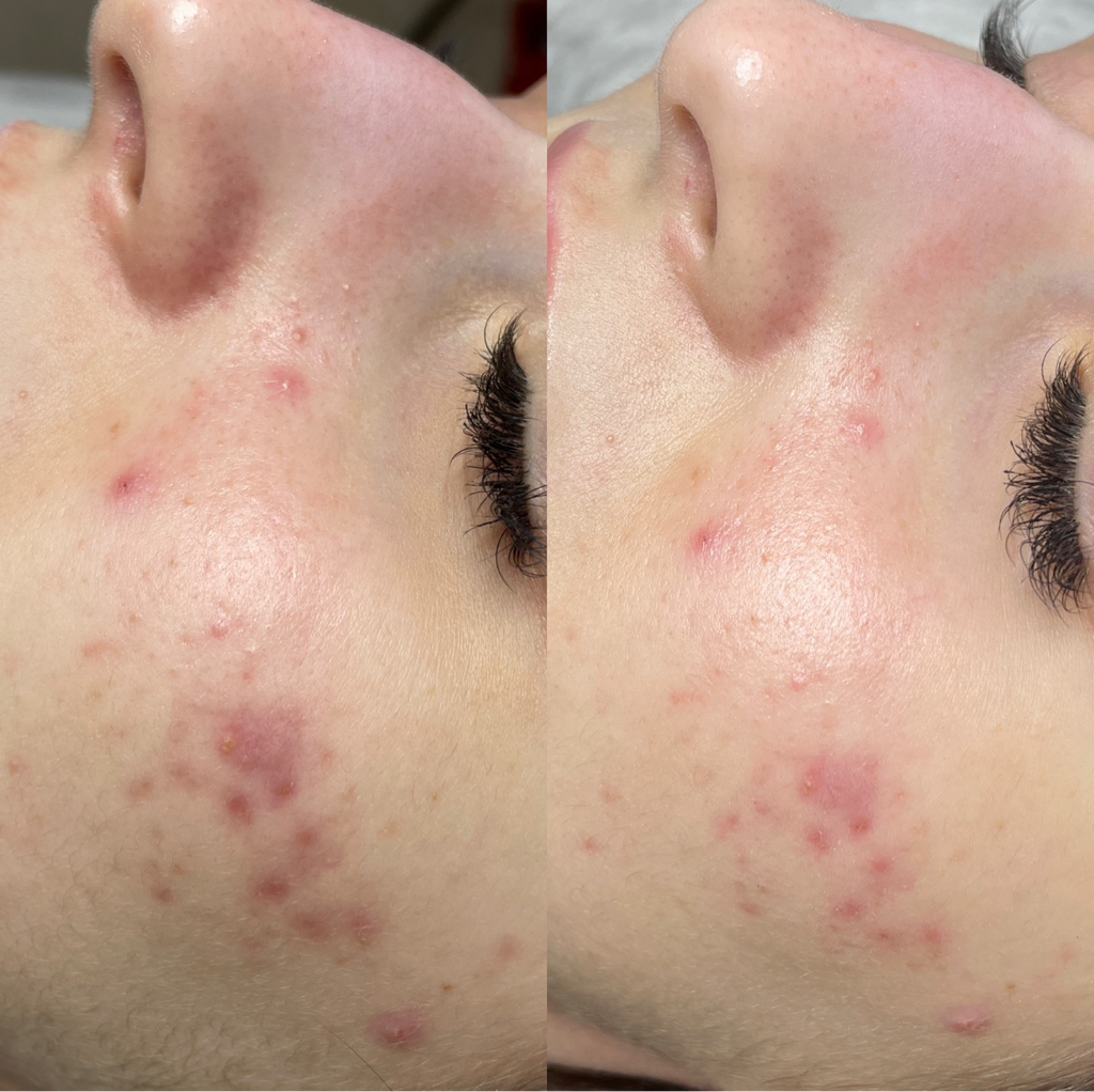 Карбоновый пилинг