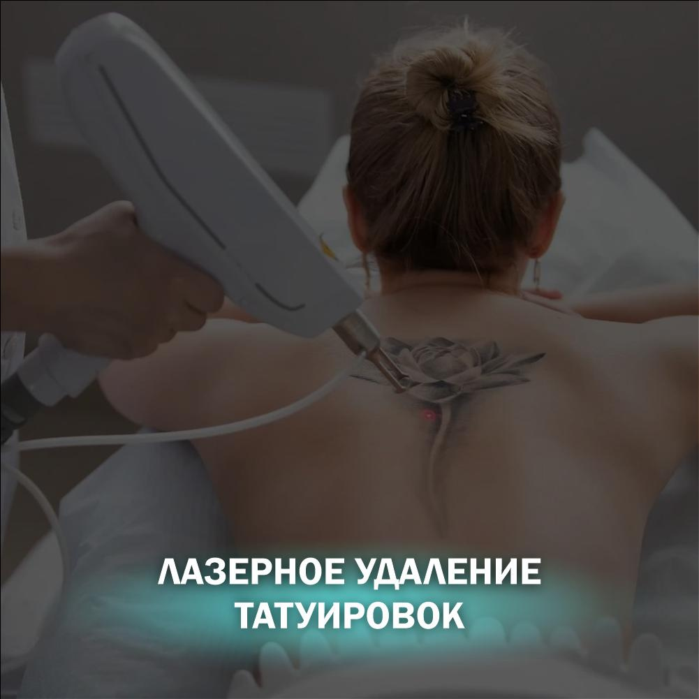 Удаление татуировок