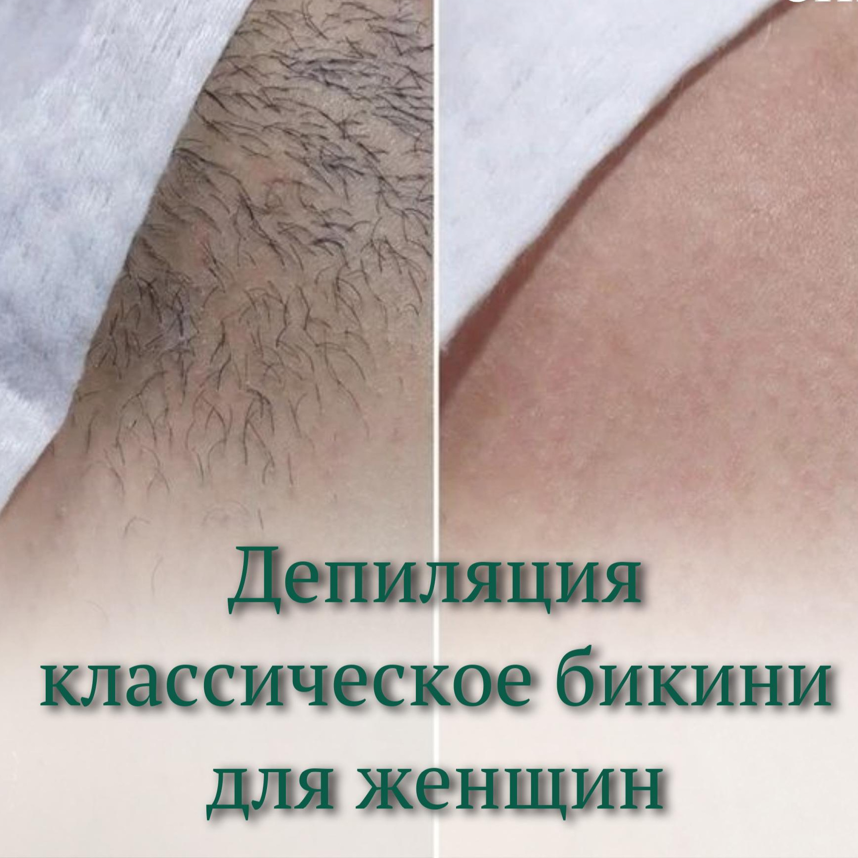 Депиляция классическое бикини