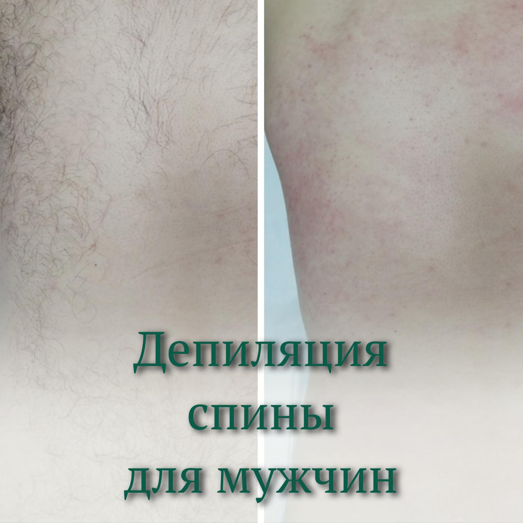 Мужская депиляция спина