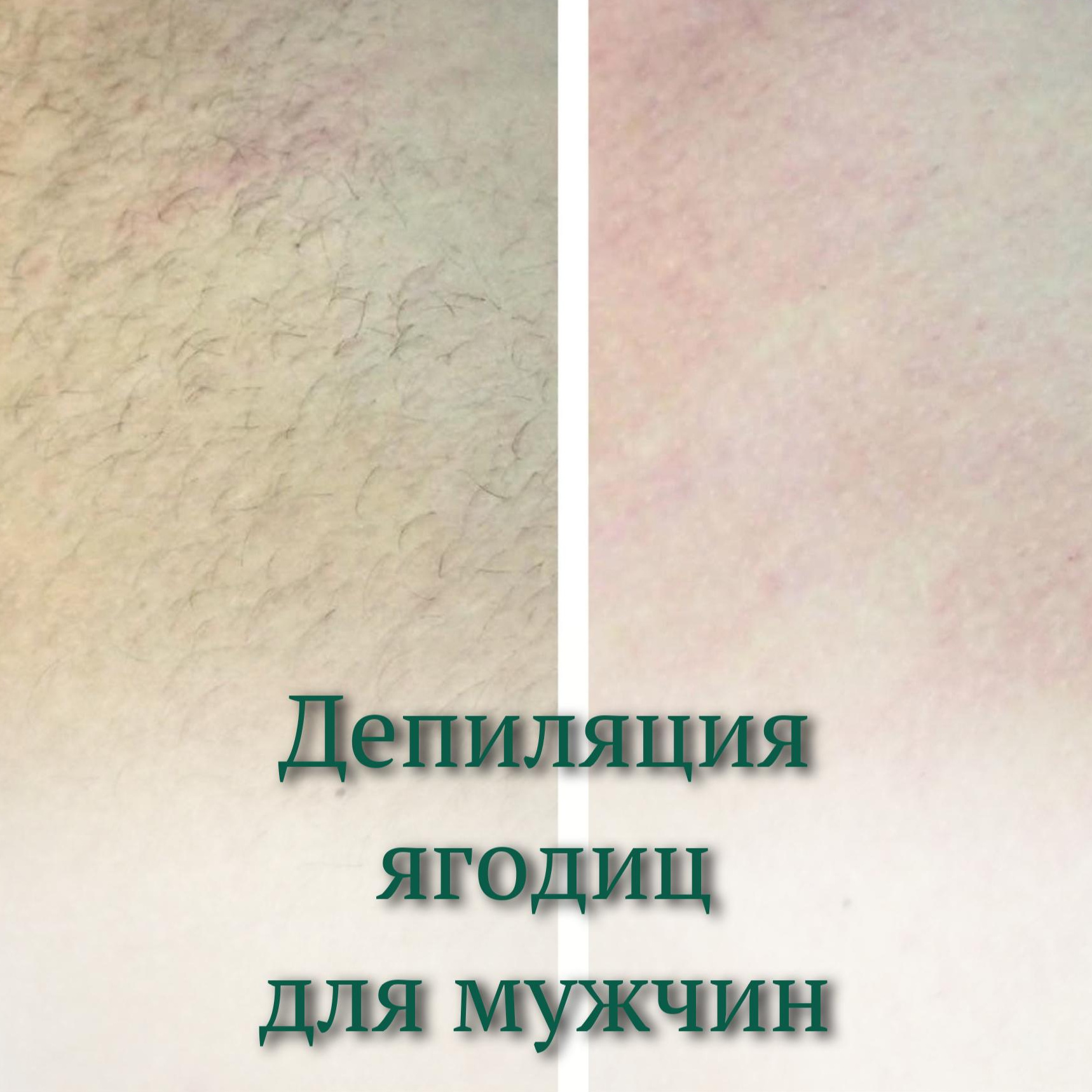 Мужская депиляция ягодицы