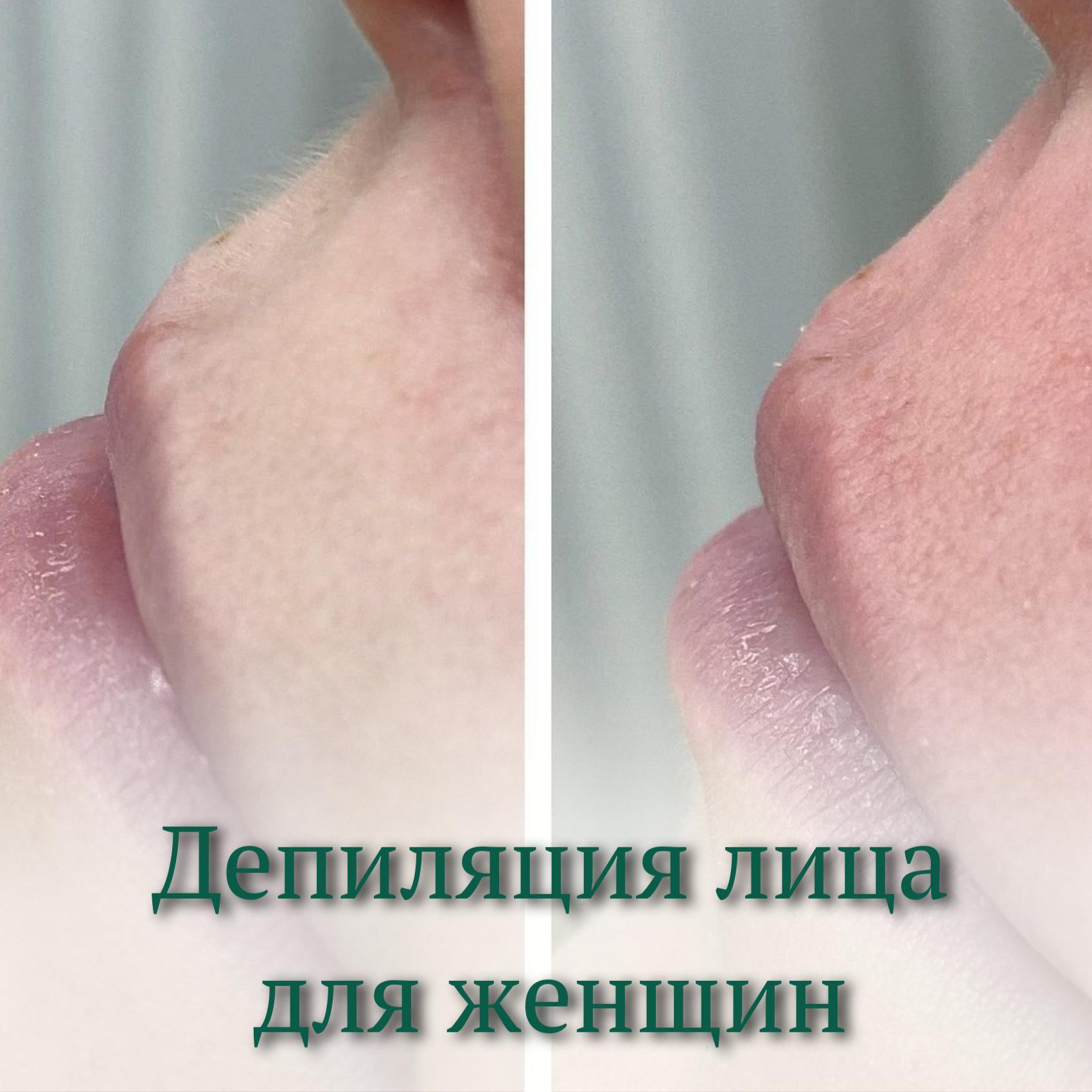 депиляция лицо (1 зона)