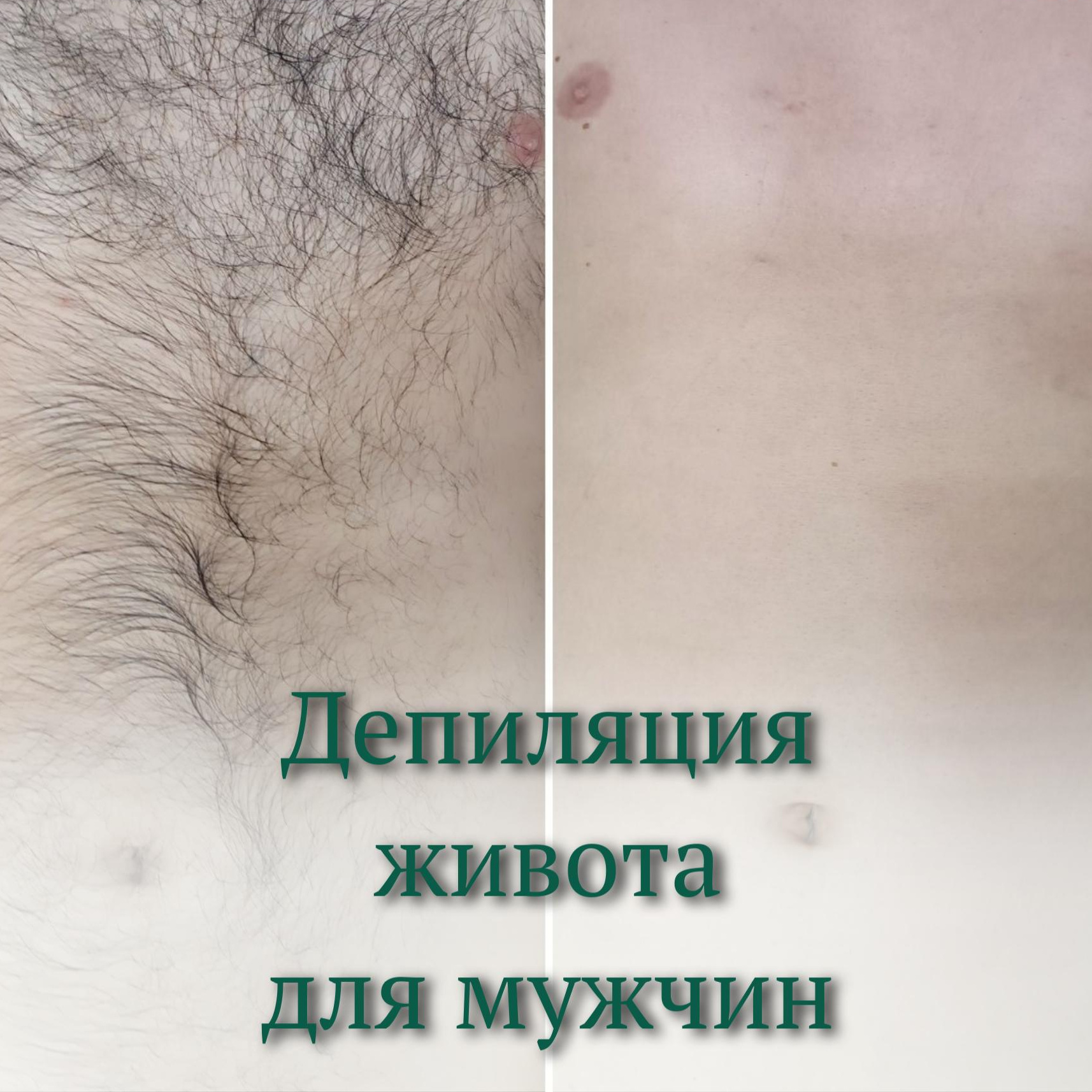 Мужская депиляция живот