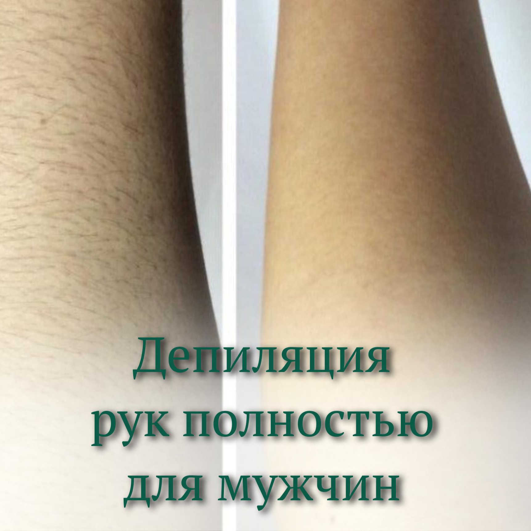 Мужская депиляция руки полностью