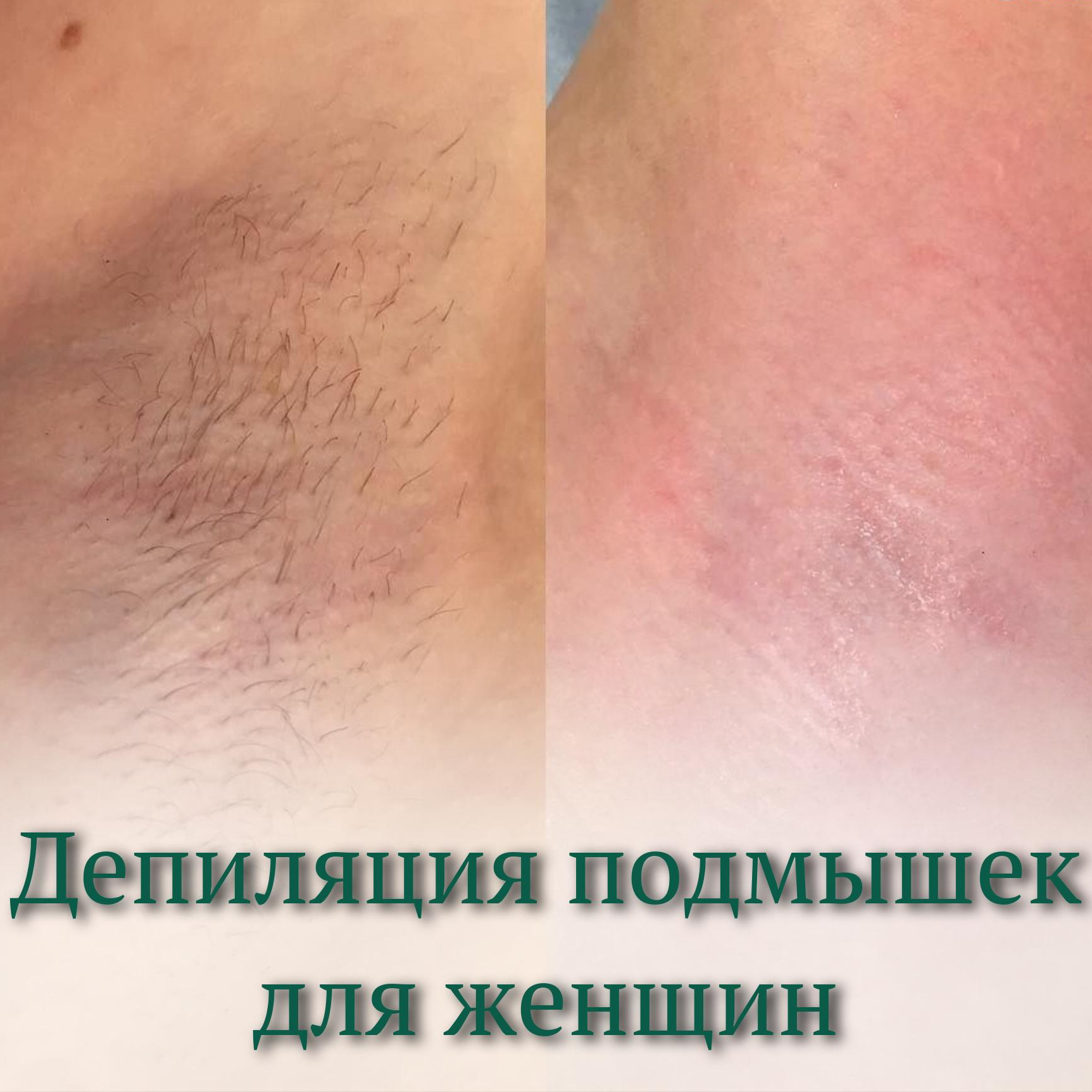 депиляция подмышки