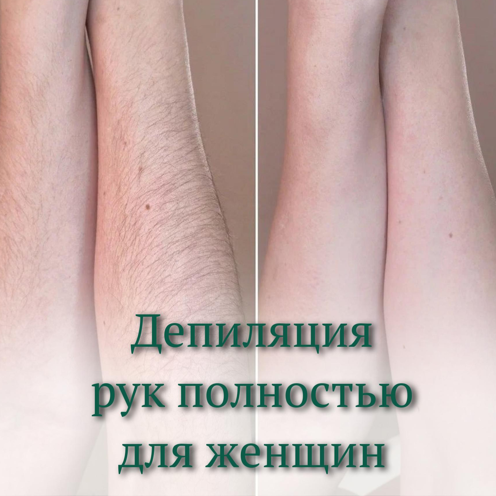 Депиляция руки полностью