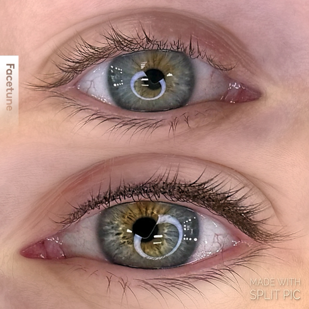 Межресничка (первичная)