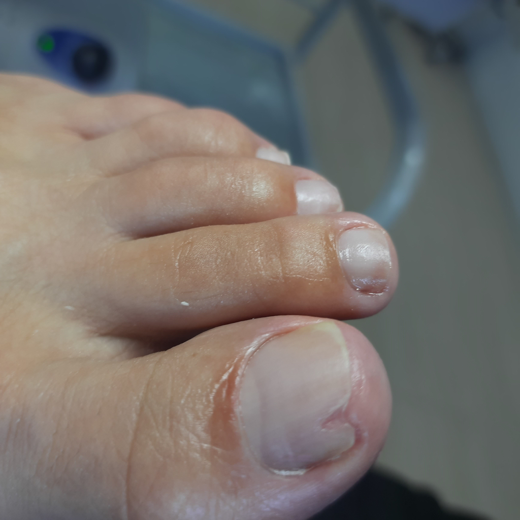 Зачистка онихолизиса