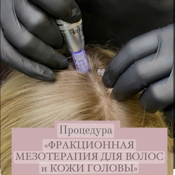 Дермапенизация для кожи головы