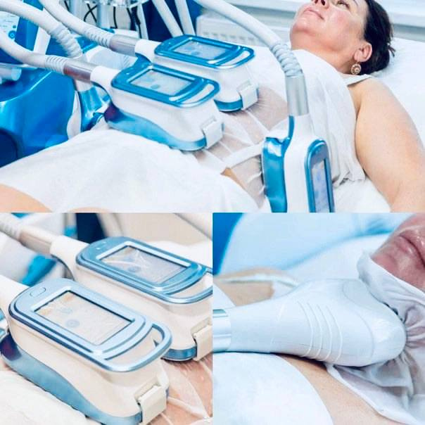 Коррекция холодом ‼️ (КРИОЛИПОЛИЗ)    5-8 манипул