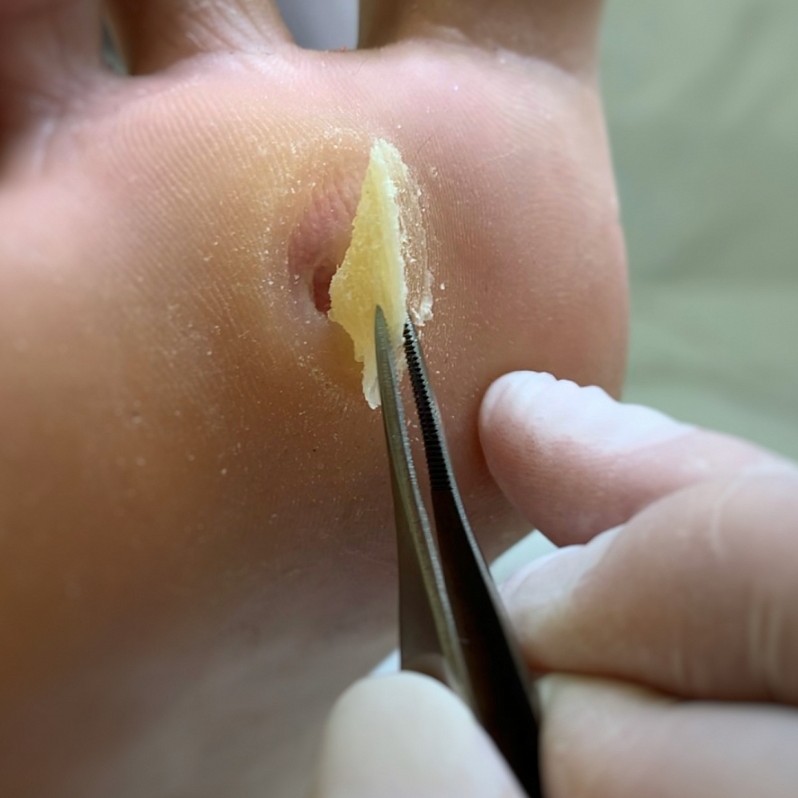 Удаление стержневой мозоли