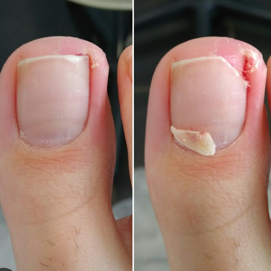 Удаление вросшего ногтя