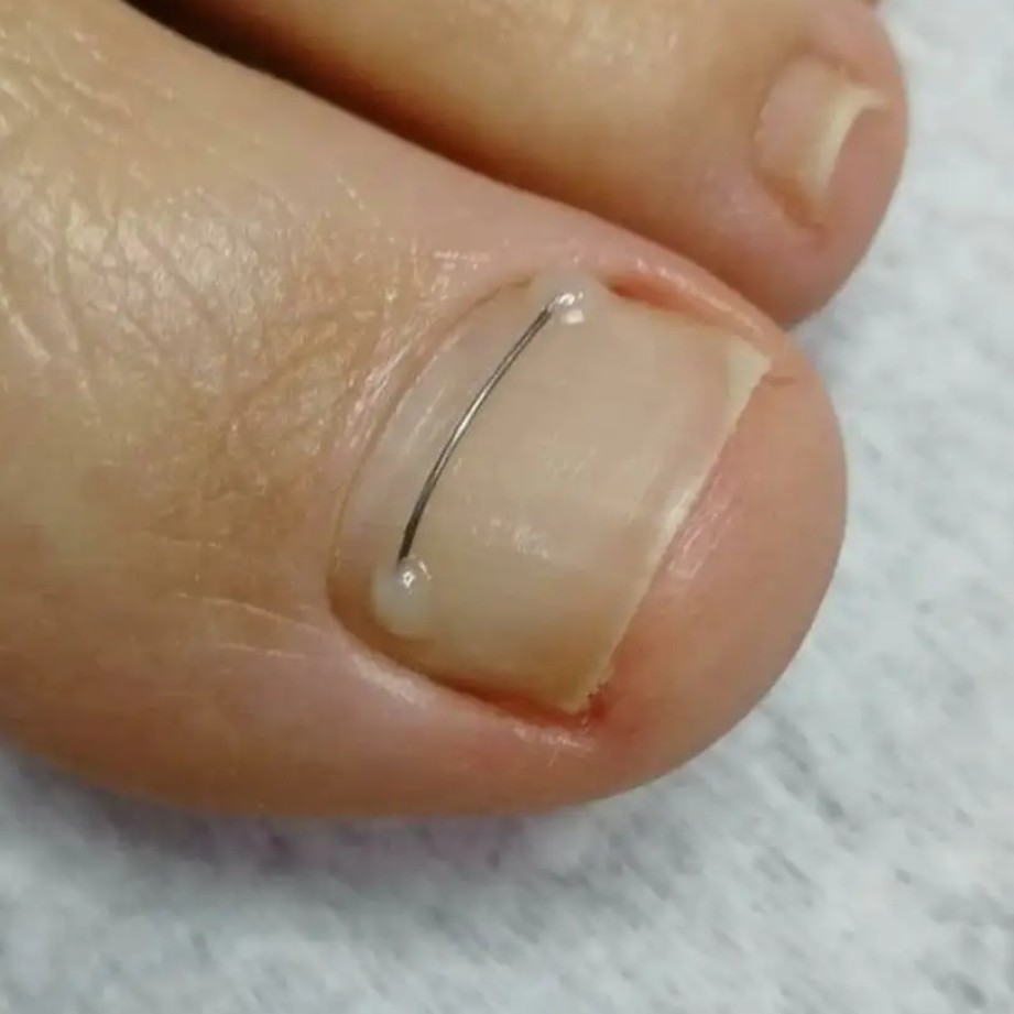 Установка коррекционной системы, титановая нить