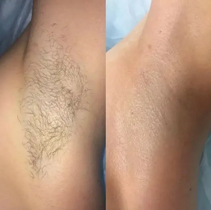 Бедра+подмышки