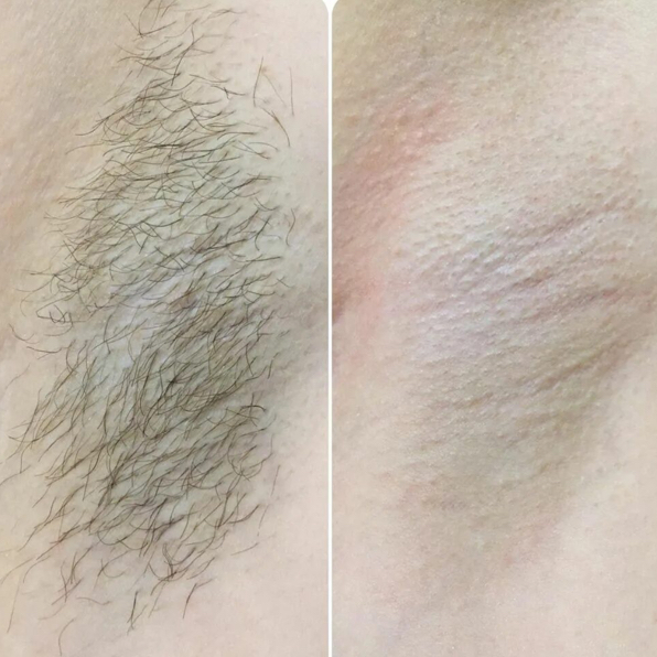 Глубокое бикини+бедра+подмышки