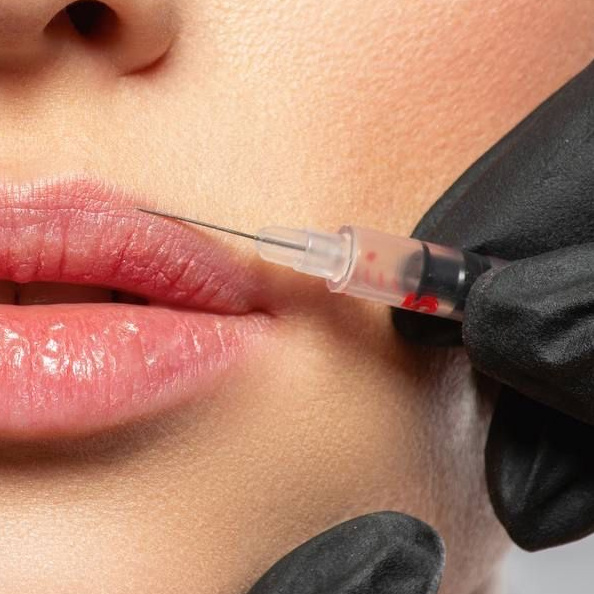 Контурная пластика губ