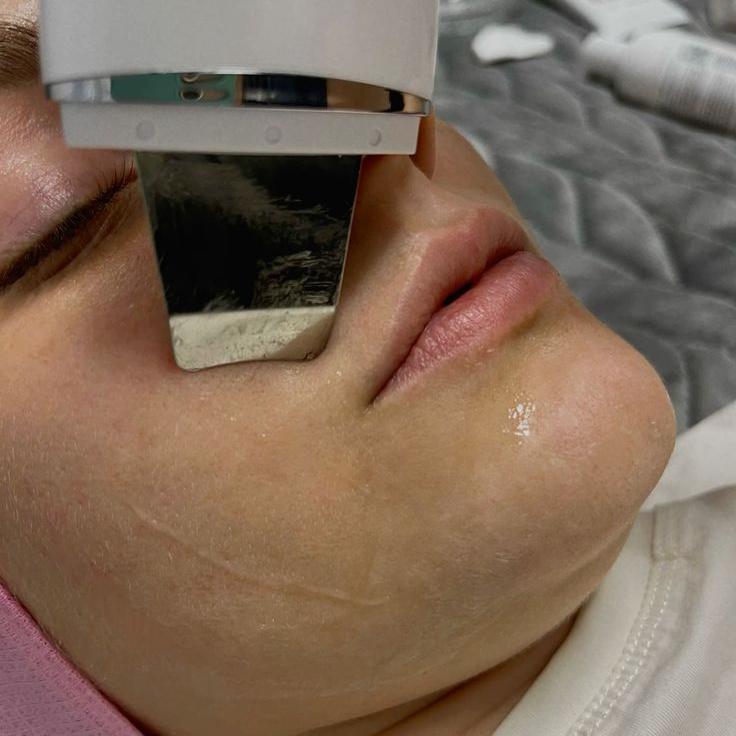 Ультразвуковая чистка лица