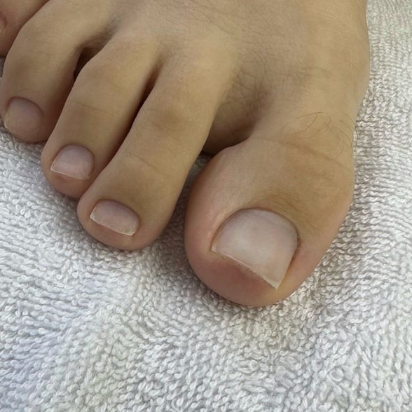 +Обработка онихолизиса 1 ноготь