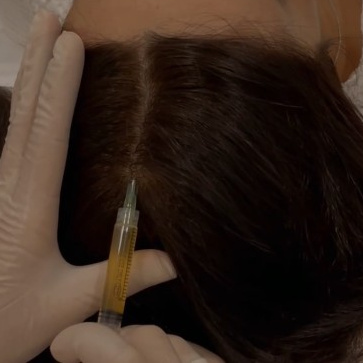 Мезотерапия головы