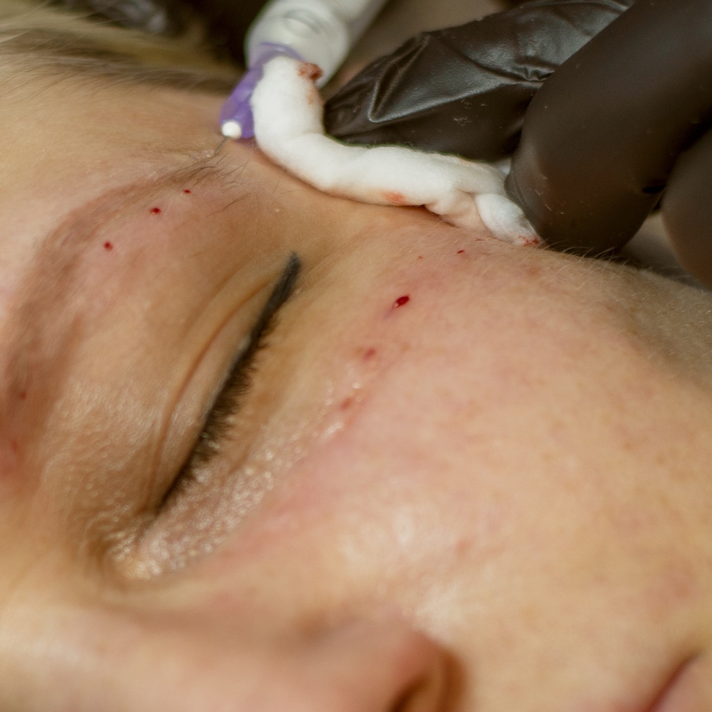 биоревитализация