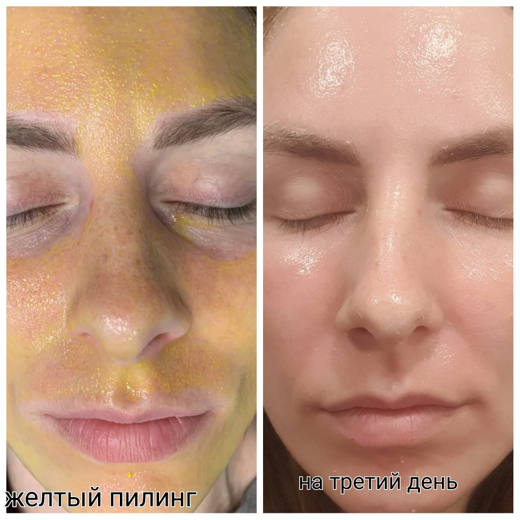 Жёлтый пилинг
