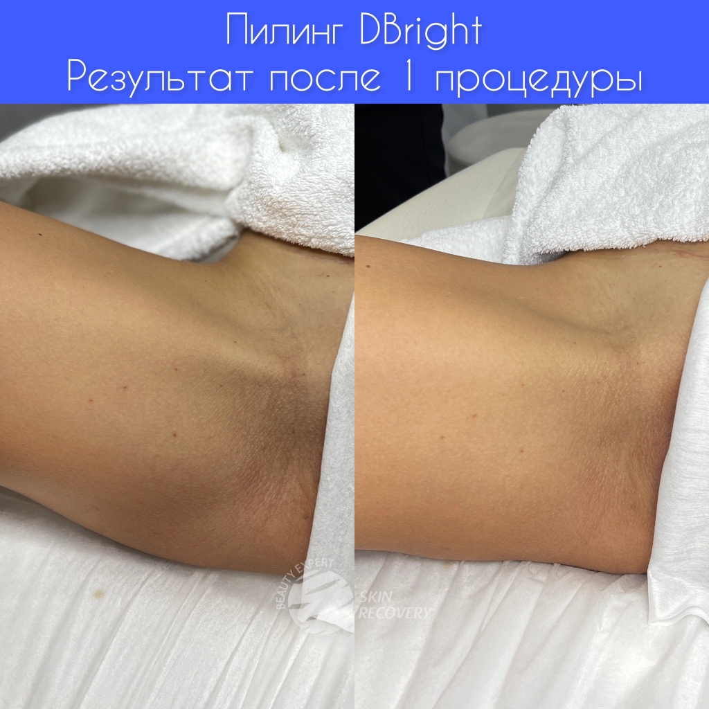 Интимное отбеливание