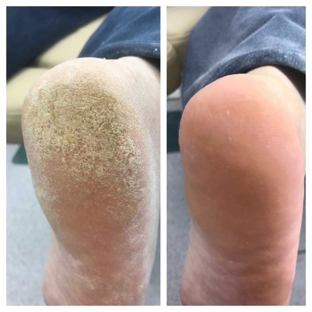 Мужской педикюр