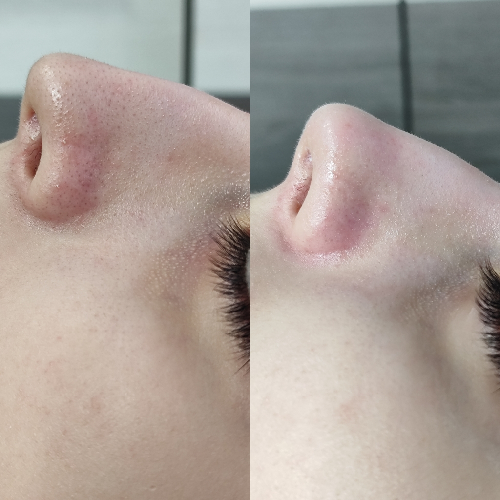 Комбинированная чистка лица + лёгкий пилинг