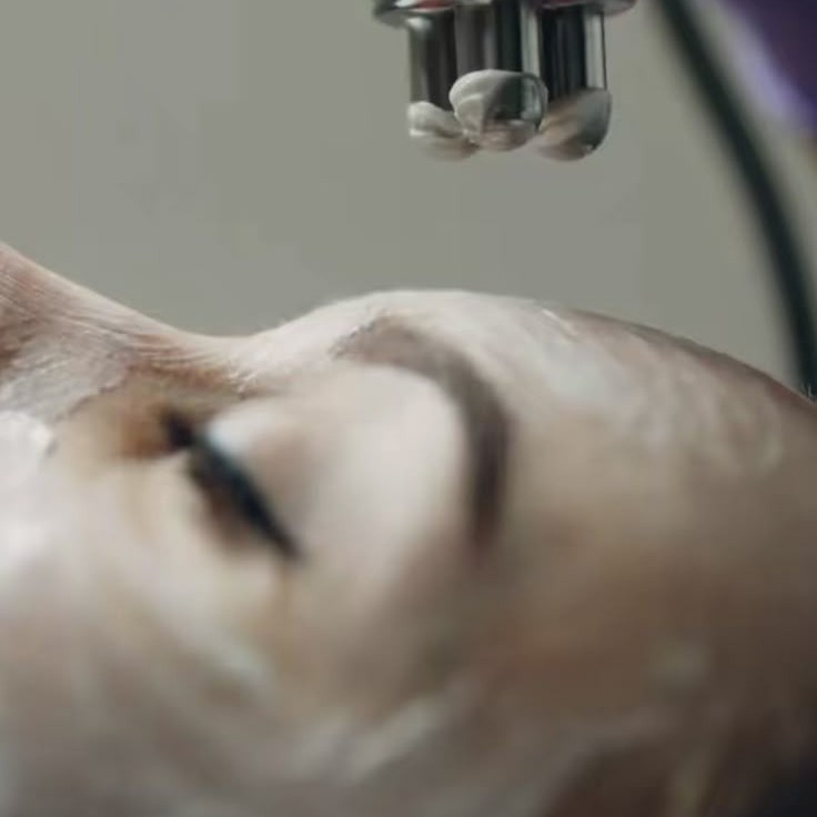 RF лифтинг - зона лицо