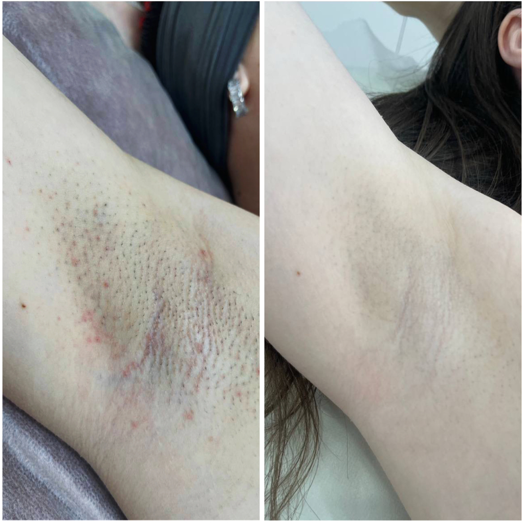 Подмышки (лазер)