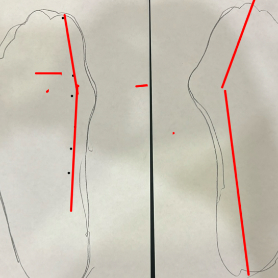 Коррекция Вальгусной деформации стопы