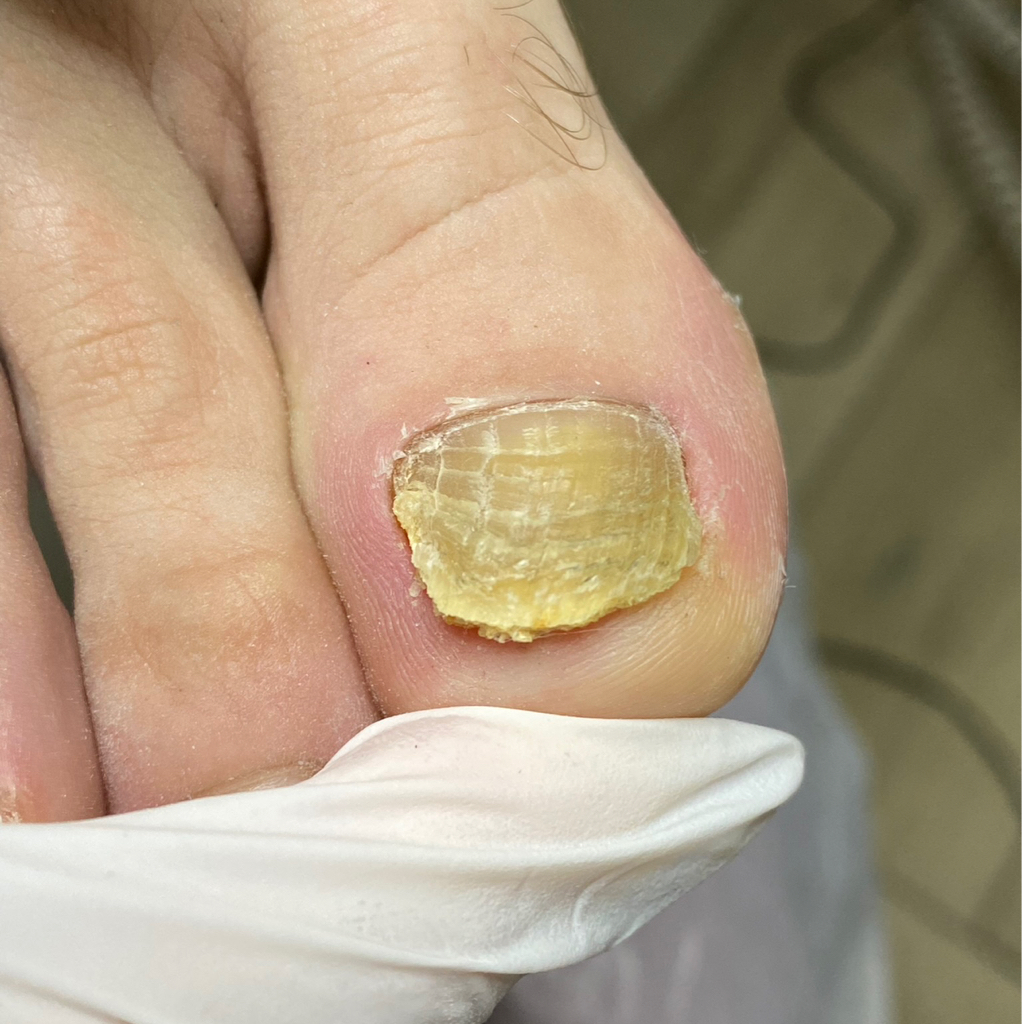 Зачистка одного ногтя пораженного грибком.