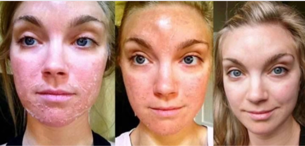 ЛИФТИНГ+⬇️МОРЩИН Пилинг ТСА (трихлоруксусный) лицо
+набор кремов