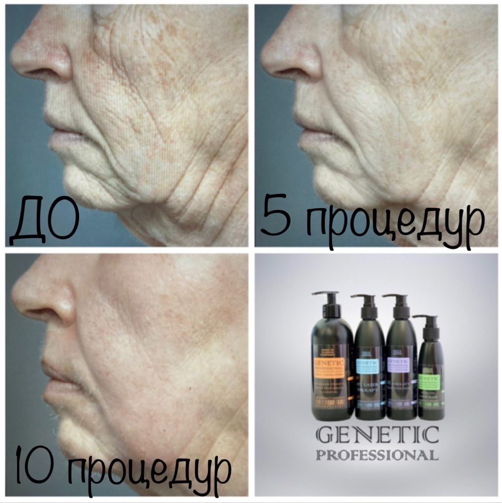 Лазерное омоложение  «ЖИДКИЙ ЛАЗЕР»