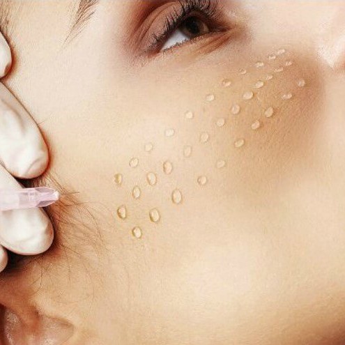 Мезотерапия неинвазивная