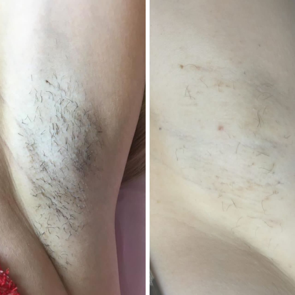 Электроэпиляция зона подмышечных впадин