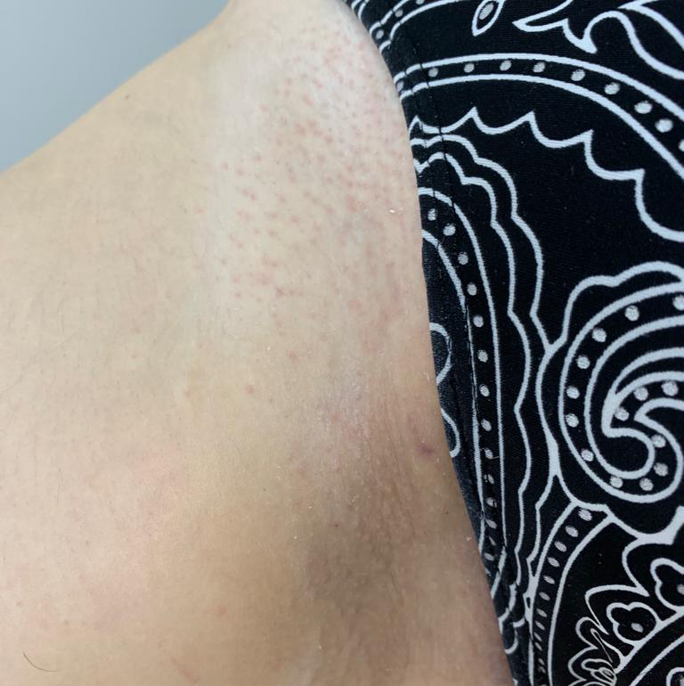 Электроэпиляция зона бикини классическое