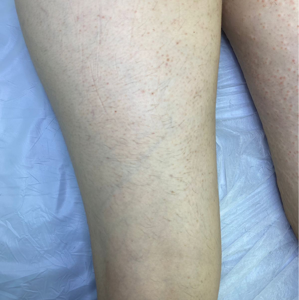 Электроэпиляция зона бедра