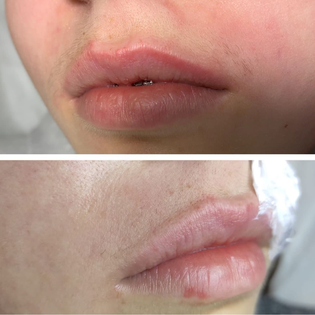 Электроэпиляция зона лица