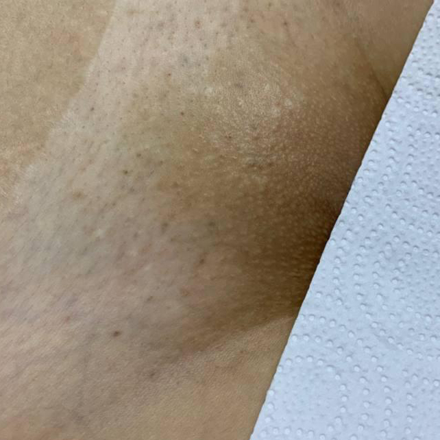 Электроэпиляция зона бикини глубокое