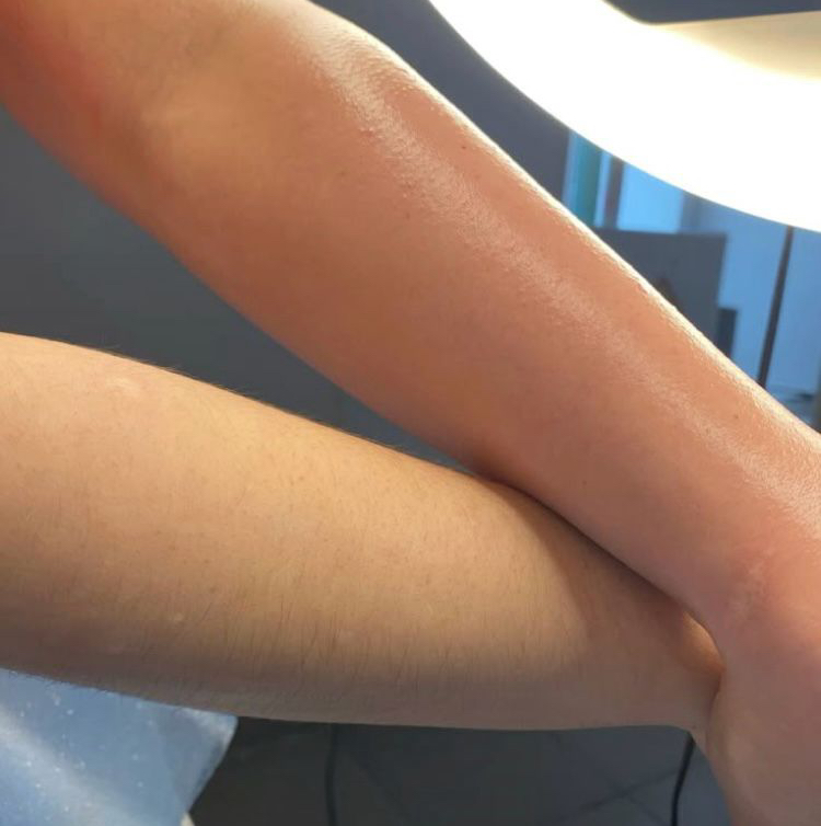 Электроэпиляция зона руки