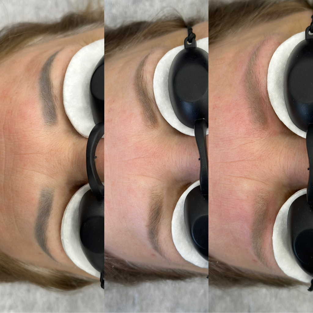 Удаление татуажа брови / губы