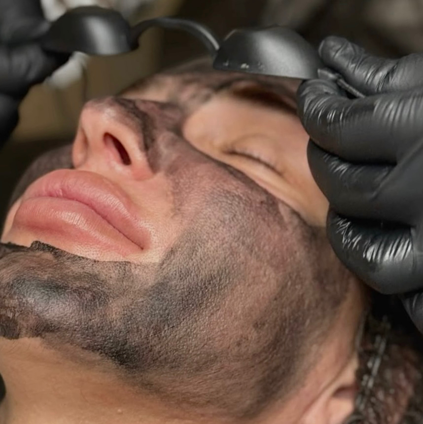 Лазерный , карбоновый  пилинг, лазерное омоложение кожи